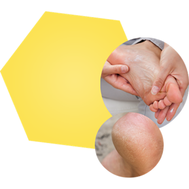 Image of moisturizing foot and another image of dry cracked heel