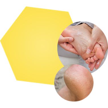 Image of moisturizing foot and another image of dry cracked heel